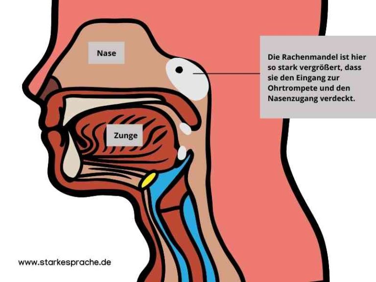 Paukenerguss und Polypen: So beeinflussen sie die Sprachentwicklung ...