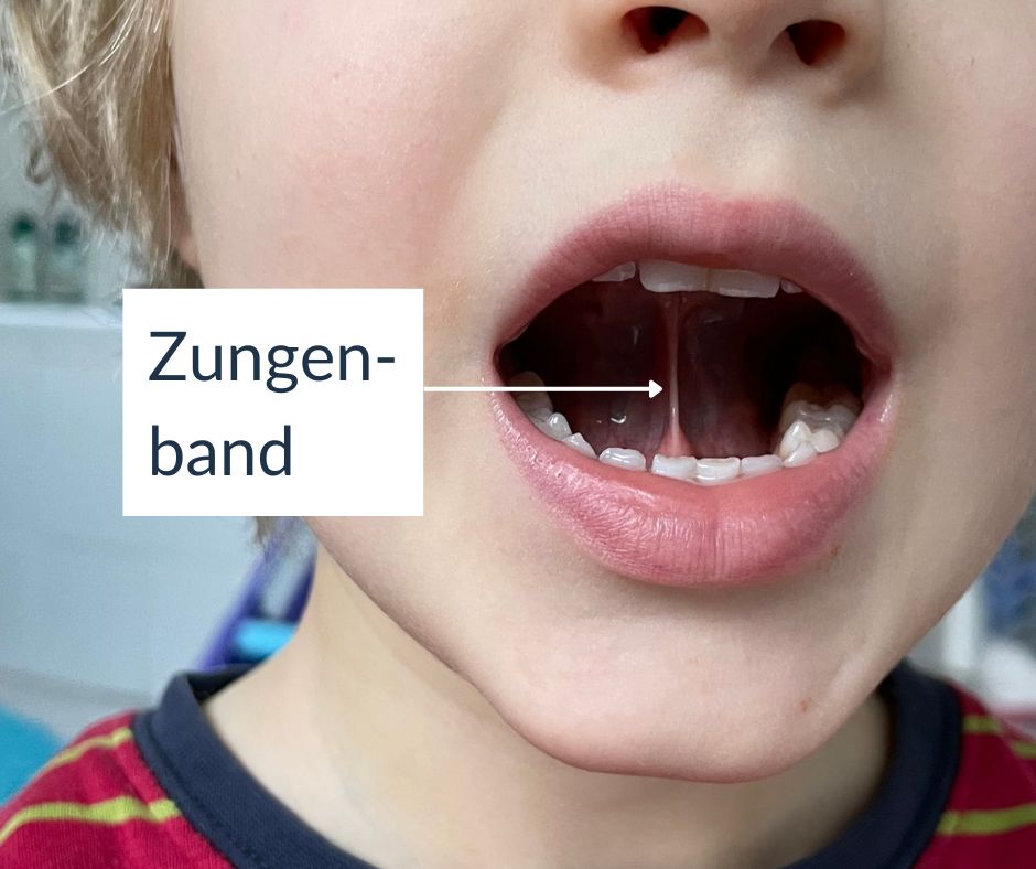 das Zungenband bei Kindern