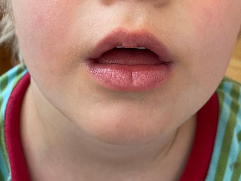 Offener Mund und Mundatmung bei Kindern