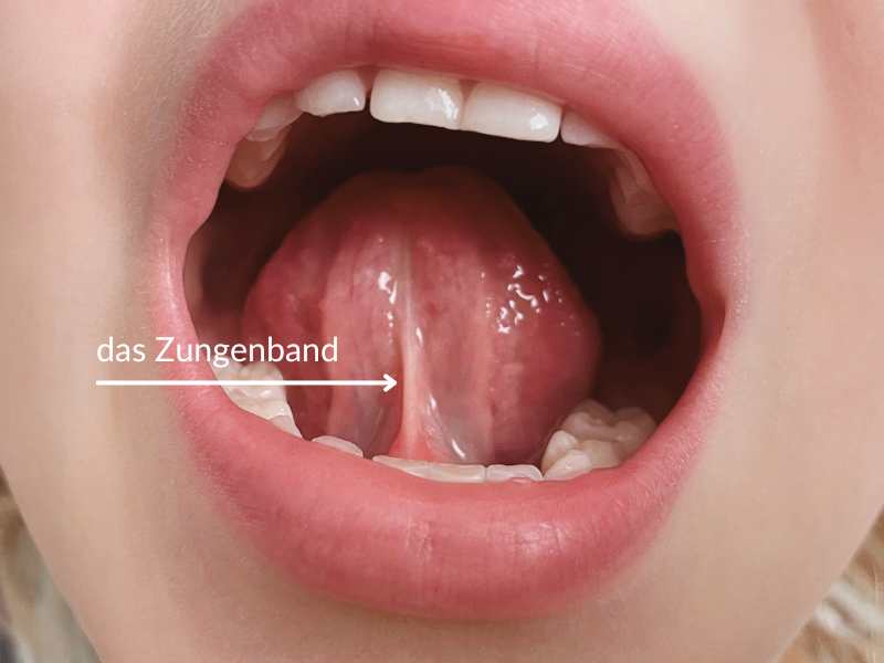 Wie erkenne ich ein zu kurzes / verkürztes Zungenband?