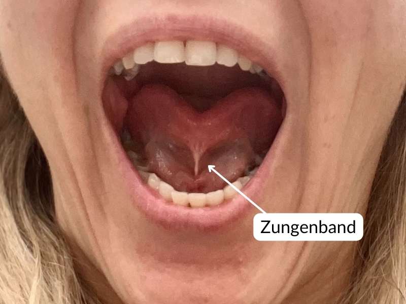 Verkürztes Zungenband 